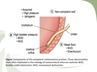 Figure: Components of the competent ureterovesical junction. Those abnormalities
most often implicated in the etiology of vesicoureteral refux are outlined. BOO,
bladder outlet obstruction; NVD, neurovesical dysfunction.
 