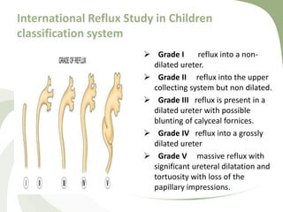 International Reflux Study in Children
classification system
 Grade I reflux into a non-
dilated ureter.
 Grade II reflux into the upper
collecting system but non dilated.
 Grade III reflux is present in a
dilated ureter with possible
blunting of calyceal fornices.
 Grade IV reflux into a grossly
dilated ureter
 Grade V massive reflux with
significant ureteral dilatation and
tortuosity with loss of the
papillary impressions.
 