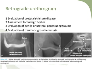 Retrograde urethrogram
1 Evaluation of ureteral stricture disease
2 Assessment for foreign bodies
3 Evaluation of penile or urethral penetrating trauma
4 Evaluation of traumatic gross hematuria
 