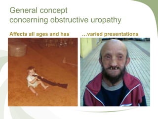 General concept
concerning obstructive uropathy
Affects all ages and has …varied presentations
 