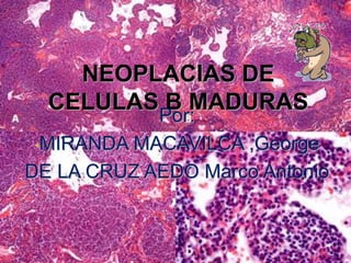 NEOPLACIAS DE
CELULAS B MADURAS
Por:
•MIRANDA MACAVILCA ,George
DE LA CRUZ AEDO Marco Antonio
 