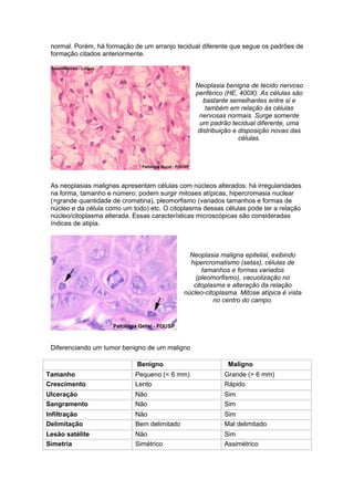 normal. Porém, há formação de um arranjo tecidual diferente que segue os padrões de
 formação citados anteriormente.



                                                 Neoplasia benigna de tecido nervoso
                                                 periférico (HE, 400X). As células são
                                                    bastante semelhantes entre si e
                                                     também em relação às células
                                                  nervosas normais. Surge somente
                                                   um padrão tecidual diferente, uma
                                                  distribuição e disposição novas das
                                                                 células.




 As neoplasias malignas apresentam células com núcleos alterados: há irregularidades
 na forma, tamanho e número; podem surgir mitoses atípicas, hipercromasia nuclear
 (=grande quantidade de cromatina), pleomorfismo (variados tamanhos e formas de
 núcleo e da célula como um todo) etc. O citoplasma dessas células pode ter a relação
 núcleo/citoplasma alterada. Essas características microscópicas são consideradas
 índices de atipia.



                                                Neoplasia maligna epitelial, exibindo
                                                hipercromatismo (setas), células de
                                                    tamanhos e formas variados
                                                  (pleomorfismo), vacuolização no
                                                 citoplasma e alteração da relação
                                              núcleo-citoplasma. Mitose atípica é vista
                                                        no centro do campo.




 Diferenciando um tumor benigno de um maligno

                             Benigno                         Maligno
Tamanho                      Pequeno (< 6 mm)               Grande (> 6 mm)
Crescimento                  Lento                          Rápido
Ulceração                    Não                            Sim
Sangramento                  Não                            Sim
Infiltração                  Não                            Sim
Delimitação                  Bem delimitado                 Mal delimitado
Lesão satélite               Não                            Sim
Simetria                     Simétrico                      Assimétrico
 
