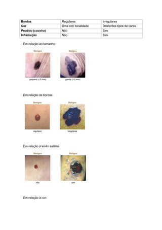 Bordas                          Regulares             Irregulares
Cor                             Uma cor/ tonalidade   Diferentes tipos de cores
Prudido (coceira)               Não                   Sim
Inflamação                      Não                   Sim

 Em relação ao tamanho:




 Em relação às bordas:




 Em relação à lesão satélite:




 Em relação à cor:
 