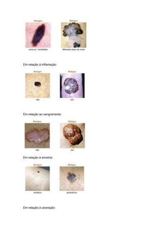 Em relação à inflamação:




Em relação ao sangramento:




Em relação à simetria:




Em relação à ulceração:
 