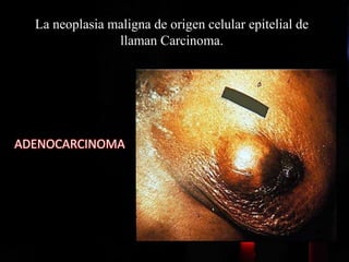 La neoplasia maligna de origen celular epitelial de
llaman Carcinoma.
ADENOCARCINOMA
 