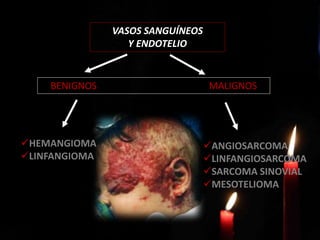 BENIGNOS MALIGNOS
VASOS SANGUÍNEOS
Y ENDOTELIO
HEMANGIOMA
LINFANGIOMA
ANGIOSARCOMA
LINFANGIOSARCOMA
SARCOMA SINOVIAL
MESOTELIOMA
 
