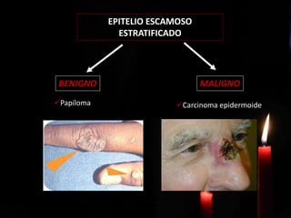 PAPILOMA ESCAMOSO
CARCINOMA DE
CÉLULAS ESCAMOSAS
EPITELIO ESCAMOSO
ESTRATIFICADO
MALIGNOBENIGNO
Papiloma Carcinoma epidermoide
 