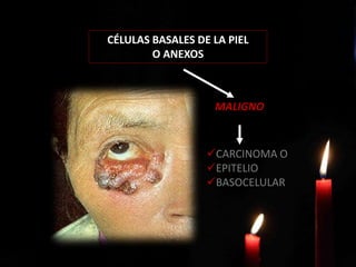 CÉLULAS BASALES DE LA PIEL
O ANEXOS
MALIGNO
CARCINOMA O
EPITELIO
BASOCELULAR
 