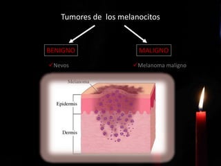 Tumores de los melanocitos
BENIGNO MALIGNO
Nevos Melanoma maligno
 