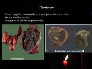 Teratomas
Tumor congénito derivado de las tres hojas embrionarias más
frecuente en los ovarios.
Se originan de células totipotenciales.
 