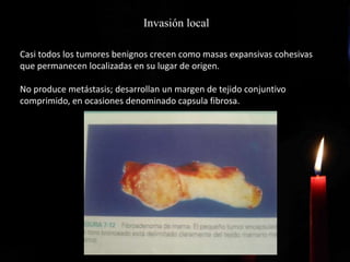 Invasión local
Casi todos los tumores benignos crecen como masas expansivas cohesivas
que permanecen localizadas en su lugar de origen.
No produce metástasis; desarrollan un margen de tejido conjuntivo
comprimido, en ocasiones denominado capsula fibrosa.
 