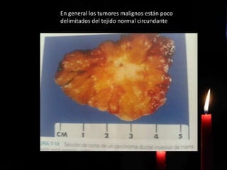 En general los tumores malignos están poco
delimitados del tejido normal circundante
 