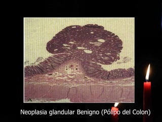 Neoplasia glandular Benigno (Pólipo del Colon)
 