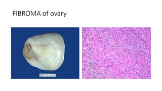 FIBROMA of ovary
 