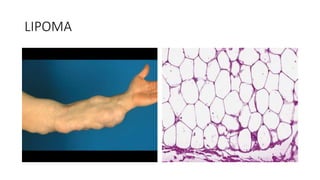 LIPOMA
 