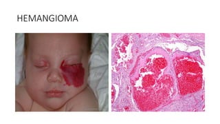 HEMANGIOMA
 