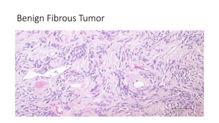 Benign Fibrous Tumor
 