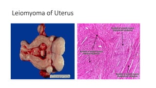 Leiomyoma of Uterus
 