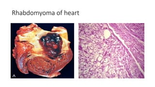 Rhabdomyoma of heart
 