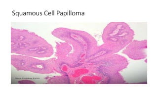 Squamous Cell Papilloma
 