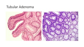 Tubular Adenoma
 