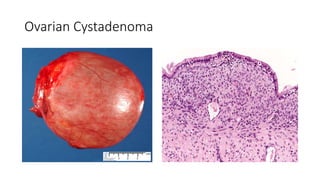 Ovarian Cystadenoma
 