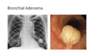 Bronchial Adenoma
 