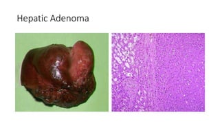 Hepatic Adenoma
 