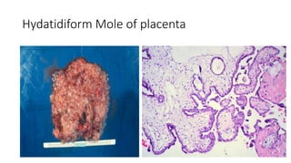 Hydatidiform Mole of placenta
 
