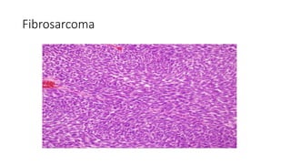 Fibrosarcoma
 