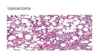 Liposarcoma
 