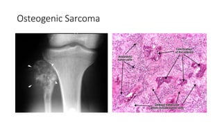 Osteogenic Sarcoma
 