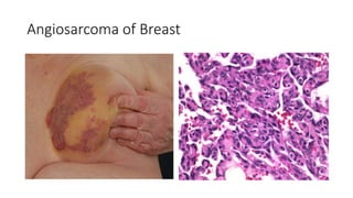 Angiosarcoma of Breast
 