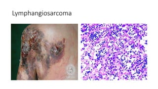 Lymphangiosarcoma
 
