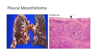 Pleural Mesothelioma
 
