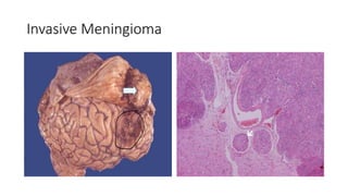 Invasive Meningioma
 