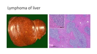 Lymphoma of liver
 