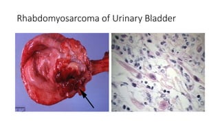 Rhabdomyosarcoma of Urinary Bladder
 