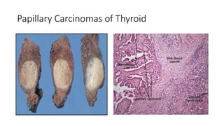 Papillary Carcinomas of Thyroid
 