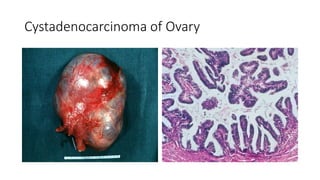 Cystadenocarcinoma of Ovary
 