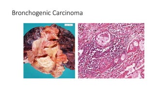 Bronchogenic Carcinoma
 
