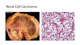Renal Cell Carcinoma
 
