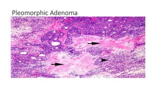 Pleomorphic Adenoma
 