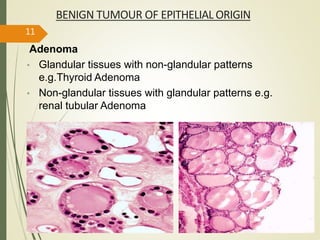 BENIGN TUMOUR OF EPITHELIAL ORIGIN
Adenoma
• Glandular tissues with non-glandular patterns
e.g.Thyroid Adenoma
• Non-glandular tissues with glandular patterns e.g.
renal tubular Adenoma
11
 
