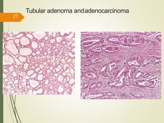Tubular adenoma andadenocarcinoma
27
 