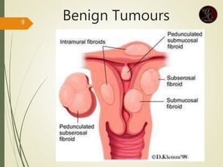 Benign Tumours
9
 