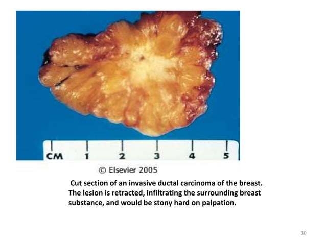 Neoplasia Presentation Complete Ppt Material Ppt