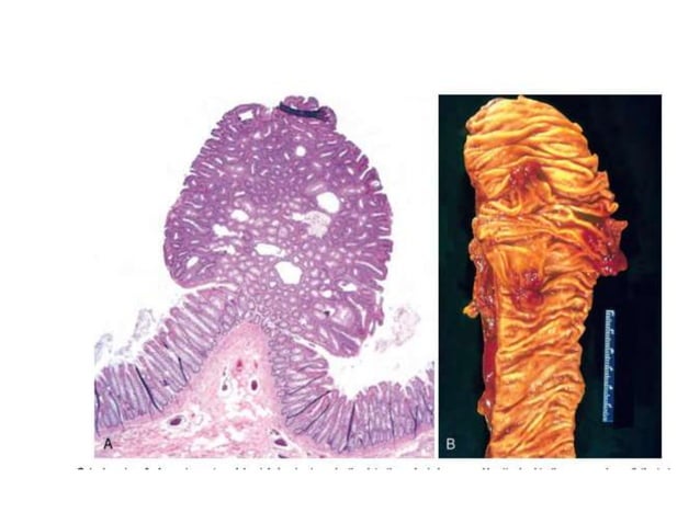 Neoplasia Presentation Complete Ppt Material Ppt