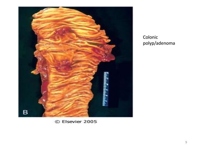 Neoplasia Presentation Complete Ppt Material Ppt