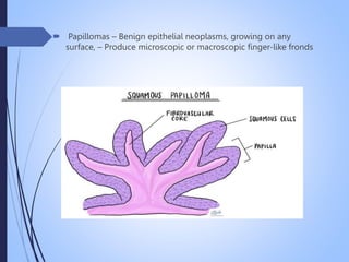  Papillomas – Benign epithelial neoplasms, growing on any
surface, – Produce microscopic or macroscopic finger-like fronds
 